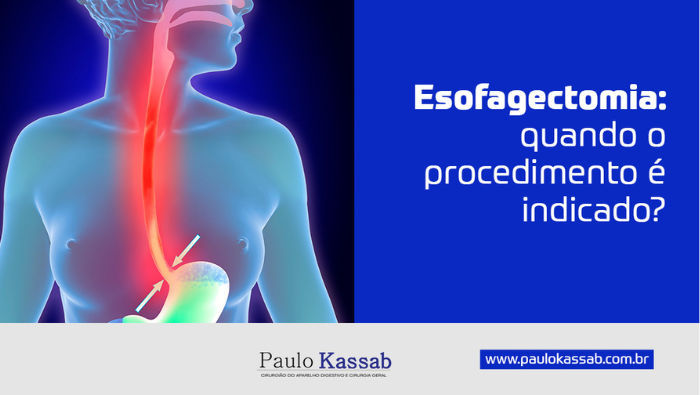 Esofagectomia: quando o procedimento é indicado? 1 Ilustração do sistema digestivo destacando esôfago e estômago, com áreas em vermelho indicando refluxo ou alteração funcional.