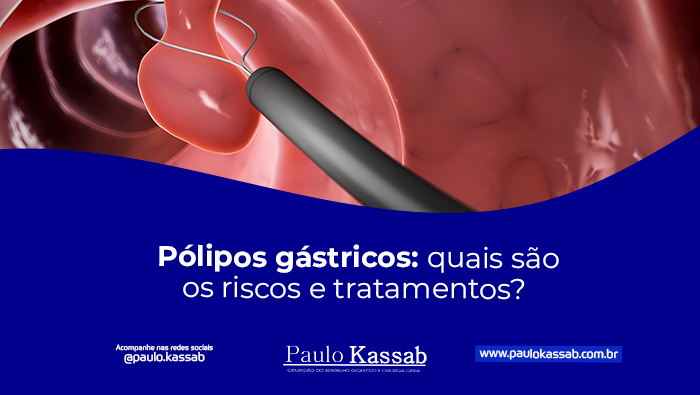 Pólipos gástricos: quais são os riscos e tratamentos? 1 Ilustração médica de pólipo no interior do trato digestivo sendo removido por instrumento endoscópico.