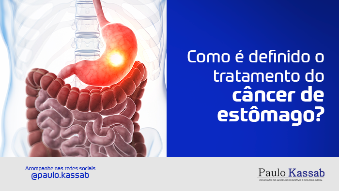Como é definido o tratamento do câncer de estômago? 1 Ilustração anatômica do sistema digestivo com destaque para o estômago, representando câncer de estômago e seu tratamento cirúrgico.